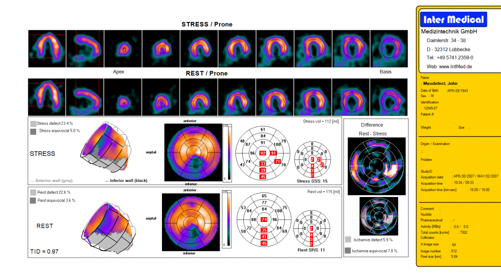 Dieses Bild zeigt eine nuklearmedizinische Bulls Eye Auswertung einer getriggerten Herz-SPECT-Aufnahme einer Gammakamera von Inter Medical Medizintechnik.