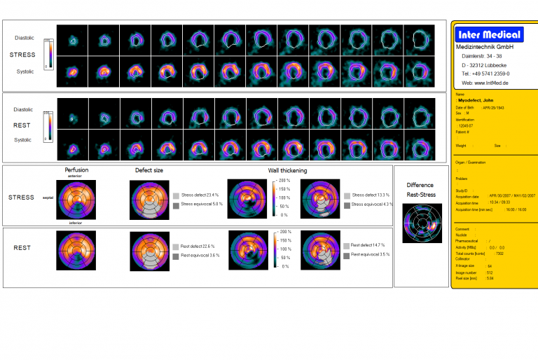 Dieses Bild zeigt eine nuklearmedizinische Bulls Eye Auswertung einer getriggerten Herz-SPECT-Aufnahme einer Gammakamera von Inter Medical Medizintechnik.
