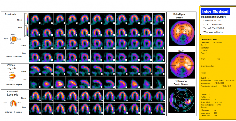 Diese Aufnahme zeigt eine nuklearmedizinische SPECT Rekonstruktion und ein Bulls Eye einer getriggerten Herz-SPECT-Aufnahme in Ruhe- und Stress-Zustand mit einer Gammakamera von Inter Medical Medizintechnik.