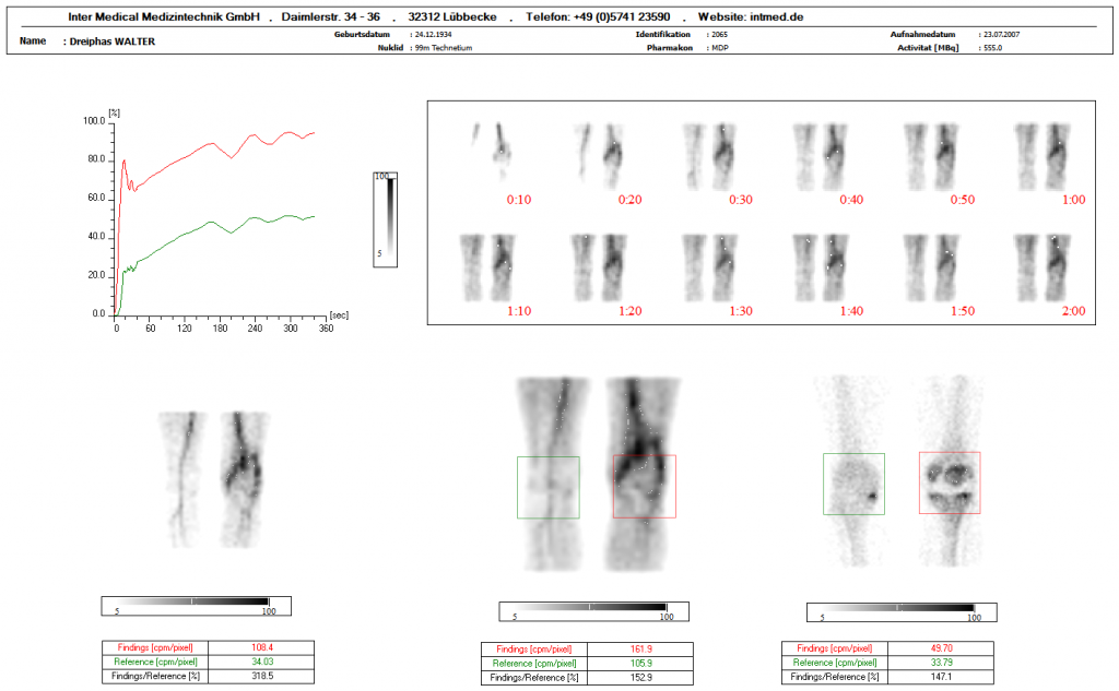 Dieses Bild zeigt eine nuklearmedizinische Ganzkörper Auswertung mit Knochen in den Kien mit der Auswertesoftware aus dem Paket Evo-Software für UniCam einer Gammakamera von Inter Medical Medizintechnik.