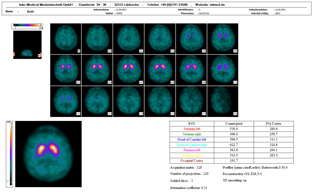 Dieses Bild zeigt eine nuklearmedizinische Hirn SPECT DATSCAN Auswertung mit der Auswertesoftware aus dem Paket Evo-Software für UniCam einer Gammakamera von Inter Medical Medizintechnik.