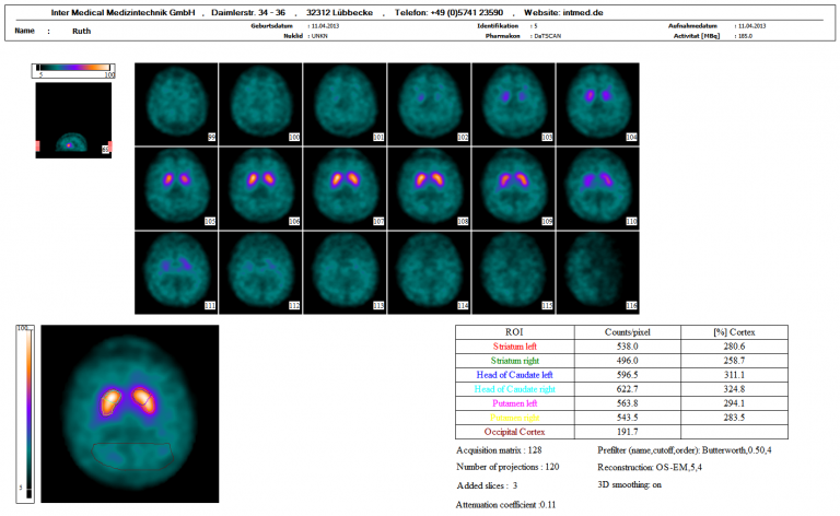 Dieses Bild zeigt eine nuklearmedizinische Hirn SPECT DATSCAN Auswertung mit der Auswertesoftware aus dem Paket Evo-Software für UniCam einer Gammakamera von Inter Medical Medizintechnik.