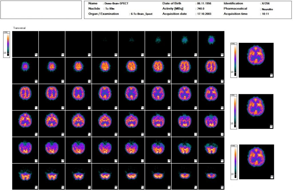 Dieses Bild zeigt eine nuklearmedizinische Hirn SPECT DatScan Auswertung mit der Auswertesoftware aus dem Paket Evo-Software für UniCam einer Gammakamera von Inter Medical Medizintechnik.