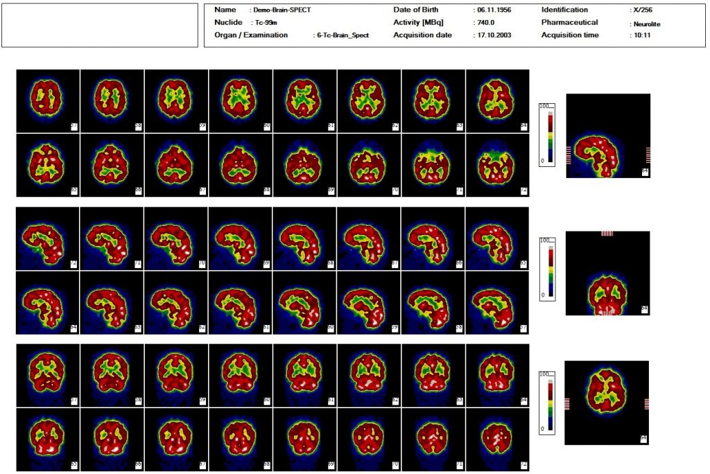 Dieses Bild zeigt eine nuklearmedizinische Hirn SPECT Datscan Auswertung mit der Auswertesoftware aus dem Paket Evo-Software für UniCam einer Gammakamera von Inter Medical Medizintechnik.