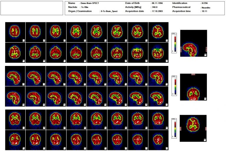 Dieses Bild zeigt eine nuklearmedizinische Hirn SPECT Datscan Auswertung mit der Auswertesoftware aus dem Paket Evo-Software für UniCam einer Gammakamera von Inter Medical Medizintechnik.
