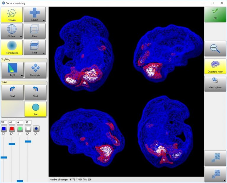 Dieses Bild zeigt eine nuklearmedizinische 3D-Darstellung eines Hirns in der Auswertung mit der Auswertesoftware aus dem Paket Evo-Software für UniCam einer Gammakamera von Inter Medical Medizintechnik.