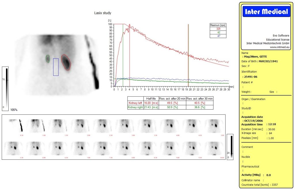 Dieses Bild zeigt eine nuklearmedizinische Nierenauswertung MAG3 mit der Auswertesoftware aus dem Paket Evo-Software für UniCam einer Gammakamera von Inter Medical Medizintechnik.