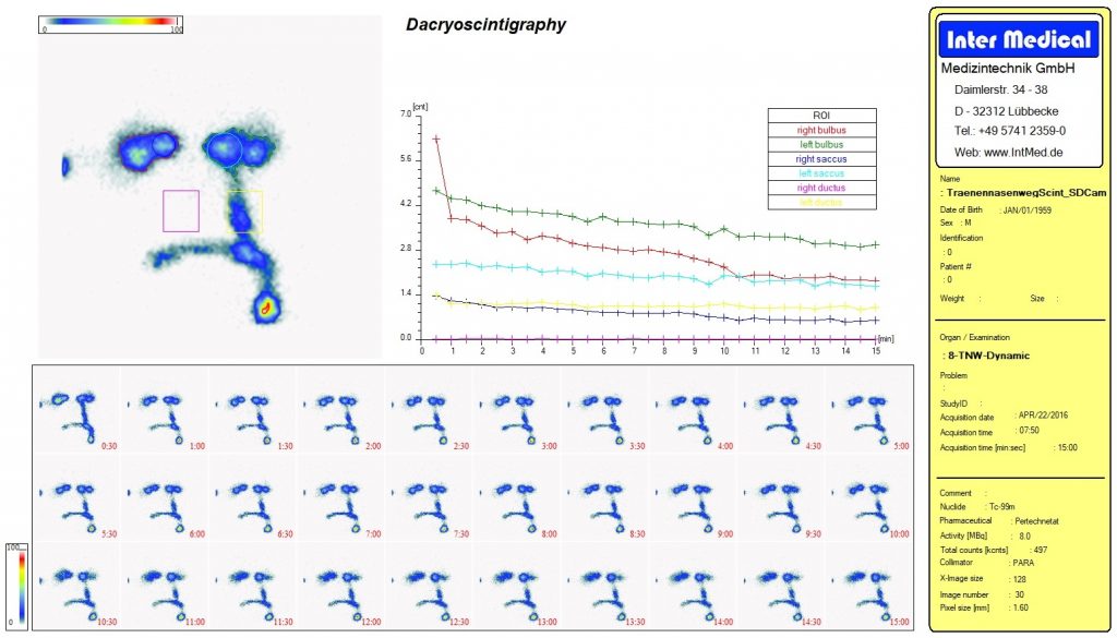 Dieses Bild zeigt eine nuklearmedizinische Organ Dacryoscintigraphy Tränennasenweg Auswertung mit der Auswertesoftware aus dem Paket Evo-Software für UniCam einer Gammakamera von Inter Medical Medizintechnik.