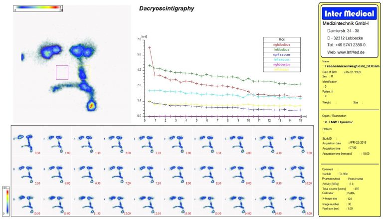 Dieses Bild zeigt eine nuklearmedizinische Organ Dacryoscintigraphy Tränennasenweg Auswertung mit der Auswertesoftware aus dem Paket Evo-Software für UniCam einer Gammakamera von Inter Medical Medizintechnik.