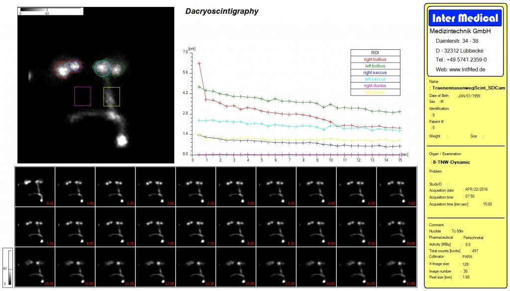 Dieses Bild zeigt eine nuklearmedizinische Organ Dacryoscintigraphy Tränennasenweg Auswertung mit der Auswertesoftware aus dem Paket Evo-Software für UniCam einer Gammakamera von Inter Medical Medizintechnik.