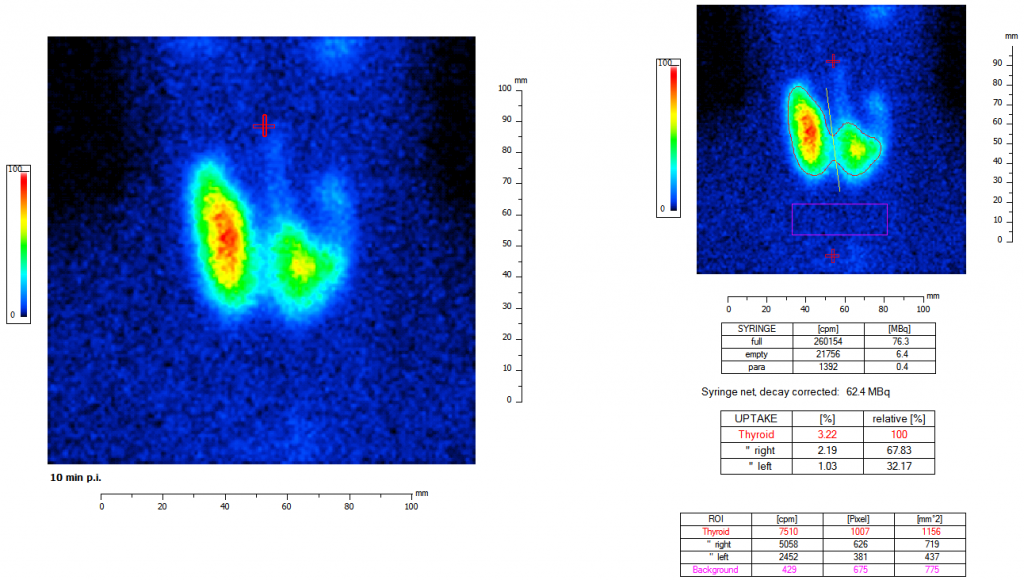 Dieses Bild zeigt eine nuklearmedizinische Schilddrüsen Auswertung mit der Auswertesoftware aus dem Paket Evo-Software für UniCam einer Gammakamera von Inter Medical Medizintechnik.