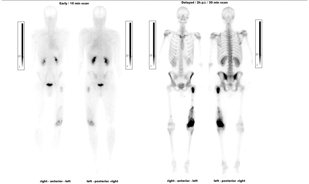 Dieses Bild zeigt eine nuklearmedizinische Knochenauswertung Ganzkörper mit Anreicherungsphase und Knochenphase mit der Auswertesoftware aus dem Paket Evo-Software für UniCam einer Gammakamera von Inter Medical Medizintechnik.