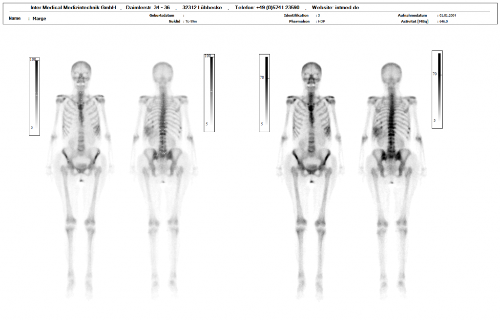 Dieses Bild zeigt eine nuklearmedizinische Ganzkörper Auswertung mit Knochen mit der Auswertesoftware aus dem Paket Evo-Software für UniCam einer Gammakamera von Inter Medical Medizintechnik.